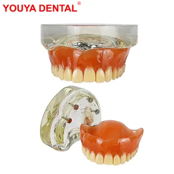 Стоматологическая модель зубов 4 Модели реставрации имплантатов Для обучения пациентов Демонстрационная модель Съемного мостовидного протеза
